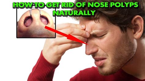 How To Get Rid Of Nose Polyps (Sinus Polyps) Naturally At Home Without S... http ...