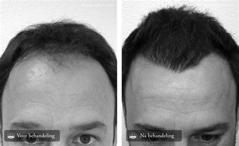 Hair Science Clinics - Hair Transplant Before and After Pictures