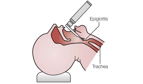 Anaesthesiology Application and Diagnostic Tips - HEINE Laryngoscope ...