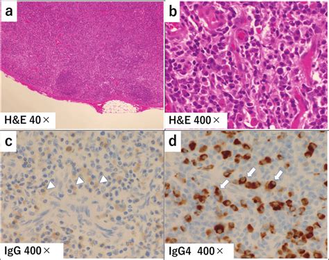 Histopathological findings of the left inguinal lymph node biopsy... | Download Scientific Diagram