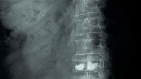 Spinal Fractures Can Be Terribly Painful. A Common Treatment Isn’t ...