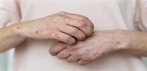 Hives: Types, Causes & Treatment | Max Lab