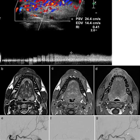 Intramuscular venous malformation in the right leg of a 5-year-old boy.... | Download Scientific ...