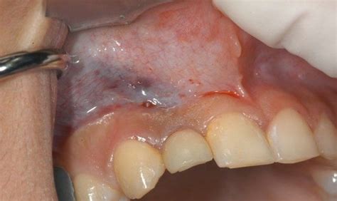 Graft Bone Dental Infection After