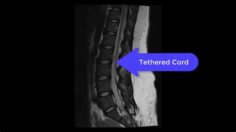 L-spine MRI, Spinal Bifida with Tethered Cord - YouTube