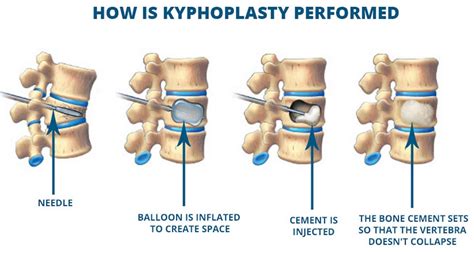 Kyphoplasty: Restore Spinal Health | Aptiva Health