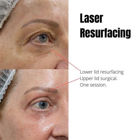 Best Erbium Laser Resurfacing In Australia | Dr Davin Lim