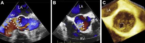 Patient with aortic regurgitation with Austin Flint diastolic murmur.... | Download Scientific ...