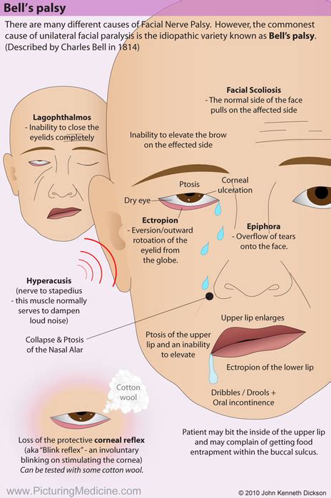 Bell's Palsy Treatment - Higgibt