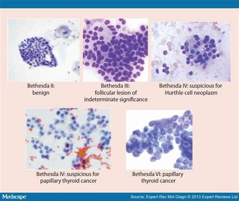 10 best Thyroid cytology images on Pinterest | Electron microscope, Lab ...