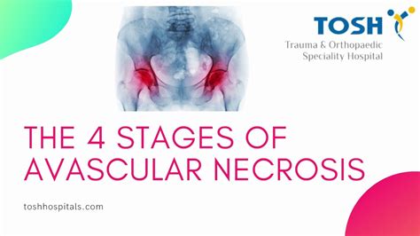 Avascular Necrosis Stages