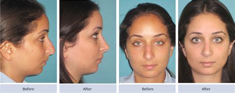 Nasal Valve Reconstruction Photos | Cosmetic Surgery NYC