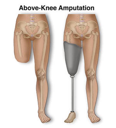 Amputation and Prosthetics - HubPages