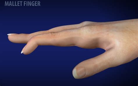 Finger Exercises Archives | Virtual Hand Care