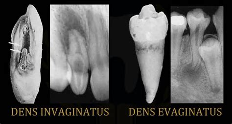 Dens Invaginatus dan Dens Evaginatus - Info DRG