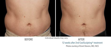 Coolsculpting Before & After Photos | Fat Freezing Technology