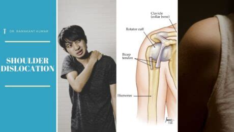 1st Shoulder Dislocation Recovery Time Archives - Dr. Ramakant Kumar