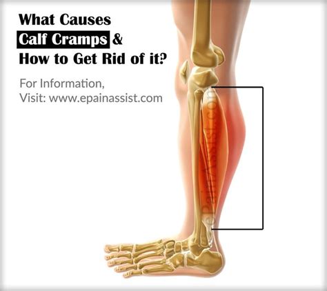 What Causes Calf Cramps & How to Get Rid of it? | Calf cramps, Calf muscle cramps, Calf muscles