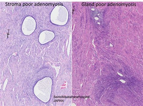 Pathology Outlines - Adenomyosis