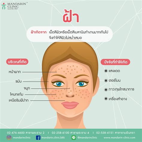 สาเหตุของการเกิดฝ้า ในทางการแพทย์แผนจีน - Mandarin Acupuncture Clinic