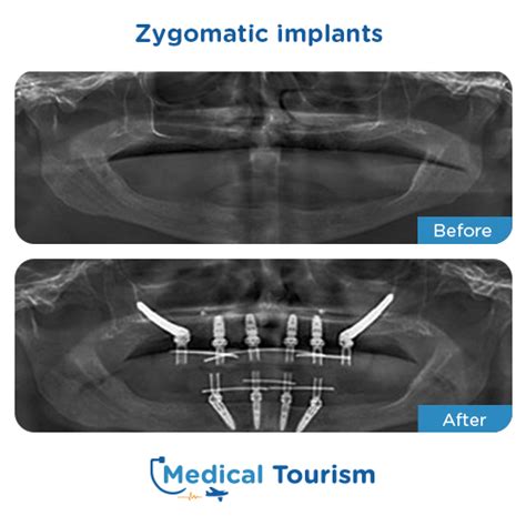 Maxillofacial Surgeons For Zygomatic Implants | Medical Tourism Mexico