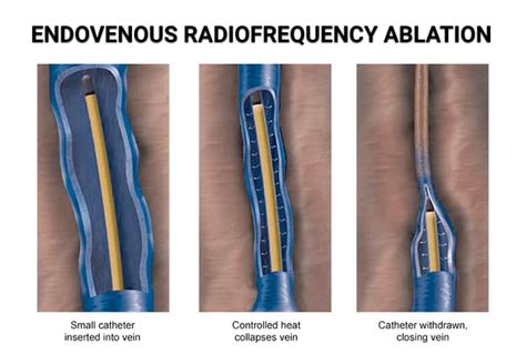 Endovenous Radiofrequency Ablation (RFA) - Vein & Endovascular Medical Care