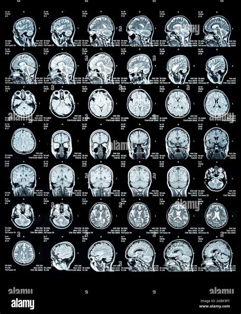 MRI Scan image of a human brain showing all main multiple sclerosis details Stock Photo - Alamy