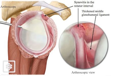 What Is Frozen Shoulder