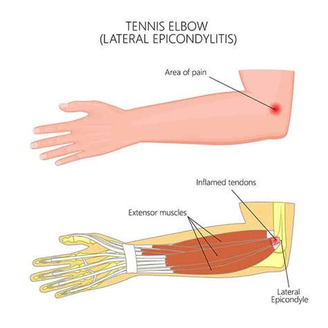 Tennis Elbow | FORM Hand, Wrist & Elbow Institute