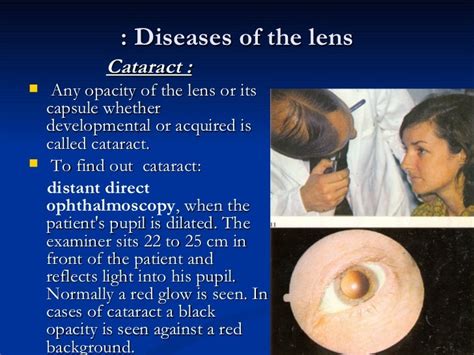 ophthalmology.Diseases of the lens.(dr.baxtyar)