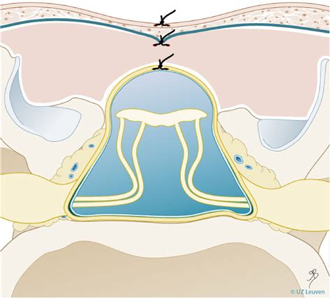 Fetal surgery for spina bifida - Obstetrics, Gynaecology and Reproductive Medicine