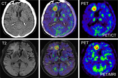 PET/CT and PET/MRI images of 56-y-old patient with glioblastoma... | Download Scientific Diagram