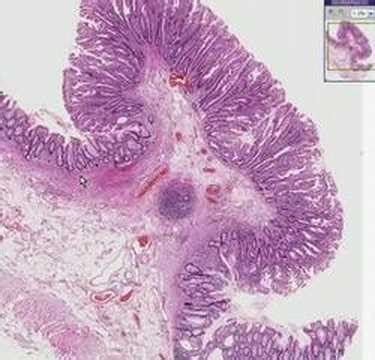 Histopathology Colon--Hyperplastic polyp - YouTube