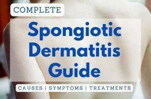 Spongiotic Dermatitis: Symptoms, Causes, Treatments