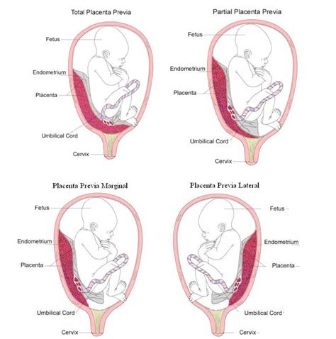 FES Iztacala Medicina (Tutorias): Placenta previa