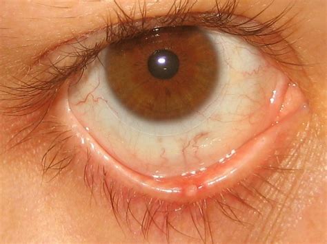 Stye - Pictures, Contagious, Symptoms, Causes, Treatment