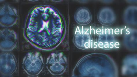 Alzheimer's Drug Aduhelm FAQ | Summit Health