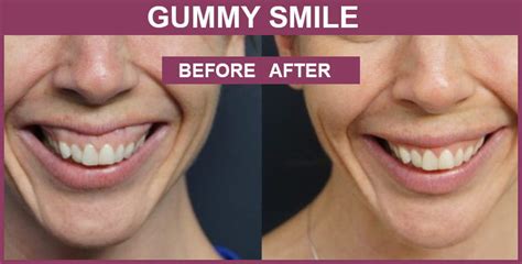 How to Fix Gummy Smile Correction with Best Treatment? | Care Well Medical Centre