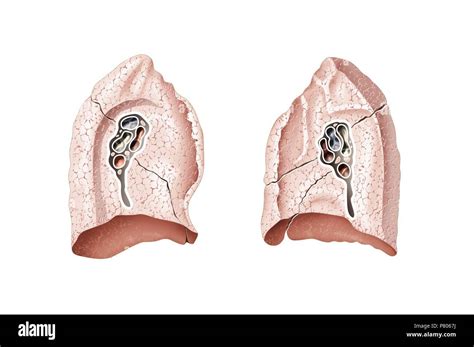 Hilum Of The Lung Anatomy And Pathology Kenhub