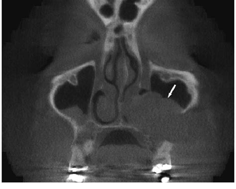 Large Maxillary Sinus Cyst