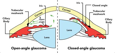 Open Vs Closed Angle Glaucoma Treatment Astigmatism Glaucoma Swollen ...