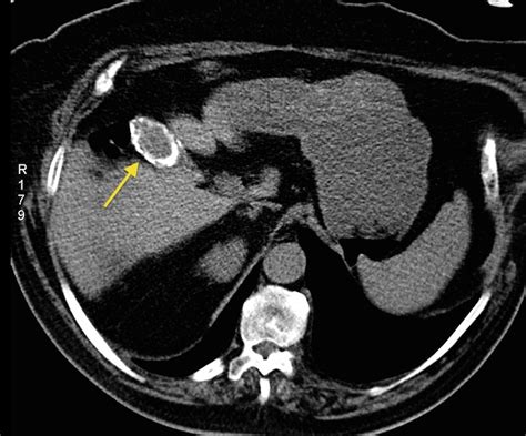 Porcelain gallbladder - Radiology at St. Vincent's University Hospital