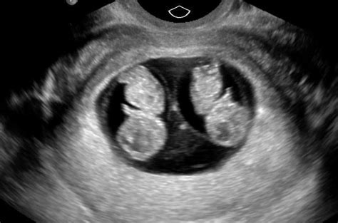 Normal first trimester 6 weeks ultrasound.