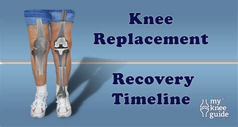 Road to Recovery following Knee Replacement | Knee replacement recovery, Knee replacement ...