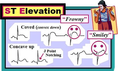 life in the fast lane ecg stemi - Laticia Baggett