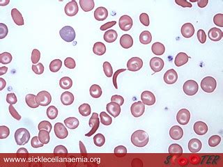 Sickle cell blood smear | Viv Caruna | Flickr