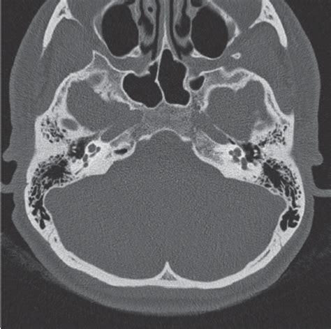 The control axial CT scan through the right-side temporal bone shows... | Download Scientific ...