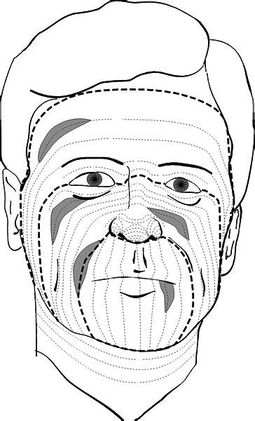 lines of tension for skin surgery | Diagrams showing the relaxed skin ...