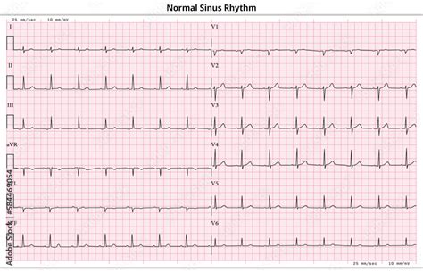 ECG Normal Sinus Rhythm - 12 Lead ECG Common Case - 6 Sec/lead - Vector ...