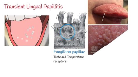 The different types of lie bumps: Transient lingual papillitis, fungiform papillae, and other ...